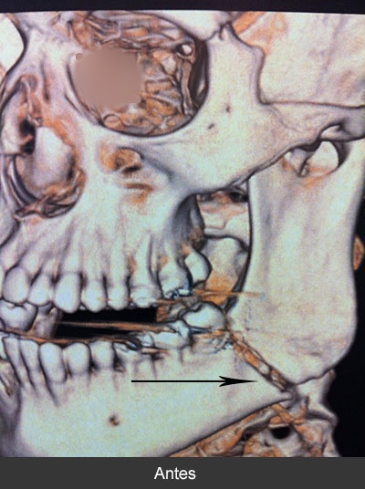Fractura de ángulo mandibular Maxilofacial CDMX
