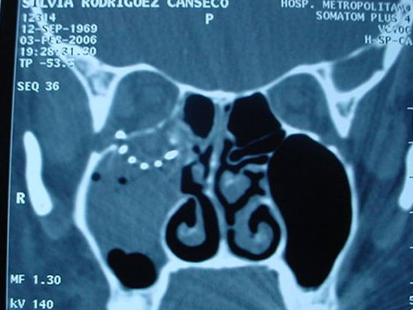 Fractura de Piso de Órbita Cirujano Maxilofacial CDMX