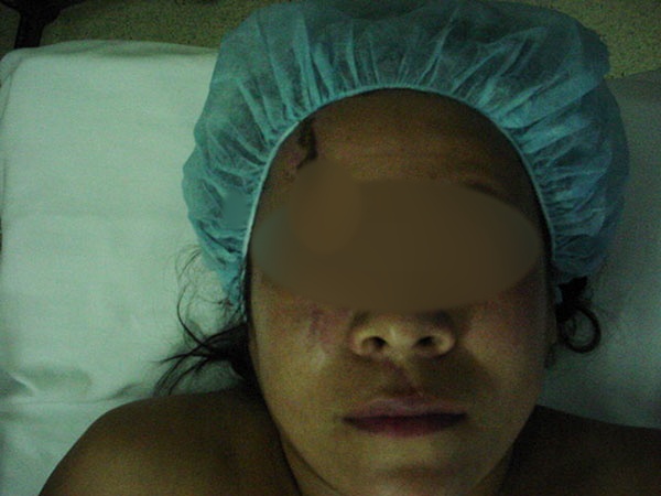 Reconstrucción Fractura de Piso de Órbita Cirujano Maxilofacial CDMX
