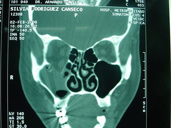 Fractura de Piso de Órbita Cirujano Maxilofacial CDMX