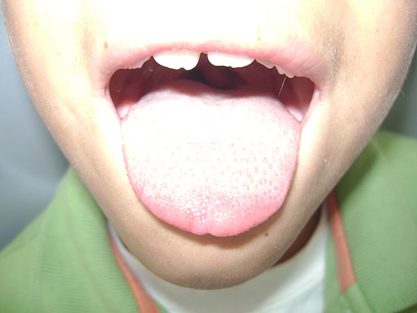 Herida en lengua Cirujano Maxilofacial CDMX