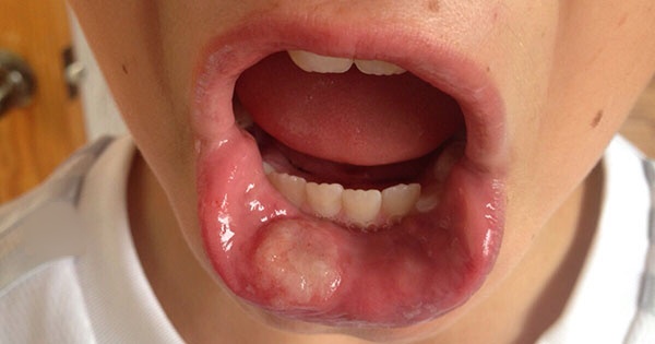 avulsión dental Maxilofacial CDMX