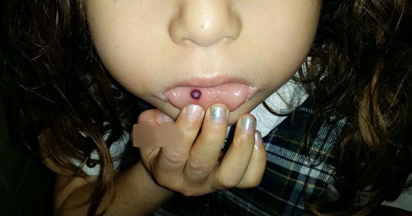 Mordedura traumática de un paciente pediátrico posterior a un tratamiento dental