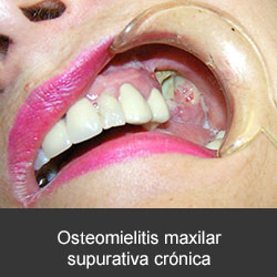 tratamiento de las infecciones dentales y cérvico faciales