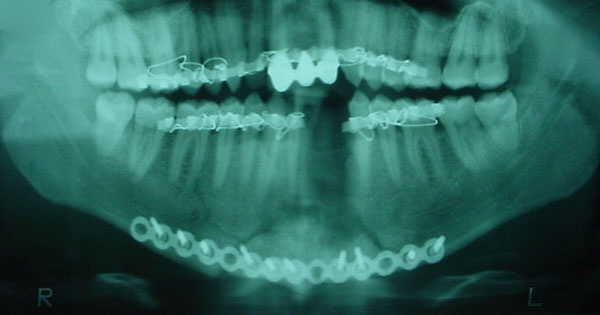 Reconstrucción Fractura por arma de fuego Cirujano Maxilofacial CDMX
