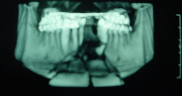 Reconstrucción Fractura por arma de fuego Cirujano Maxilofacial CDMX