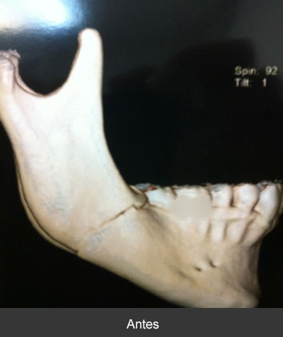 Fractura de ángulo mandibular Maxilofacial CDMX