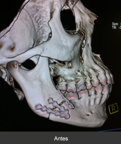 Fractura de ángulo mandibular Cirujano Maxilofacial CDMX
