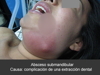 Diagnóstico y tratamiento de las infecciones dentales en CDMX