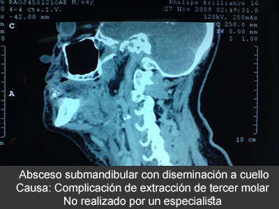 Diagnóstico y tratamiento de las infecciones dentales