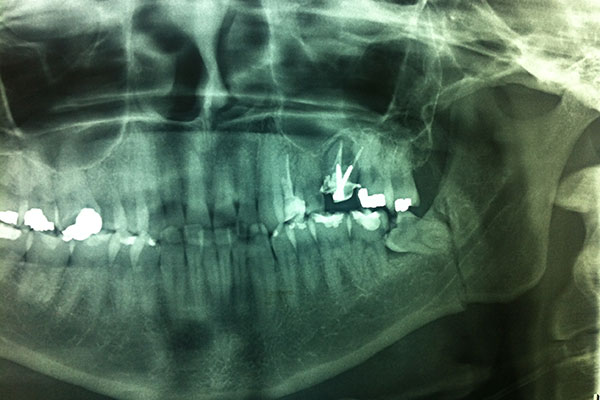 Reconstrucción Fractura mandibular Cirujano Maxilofacial CDMX