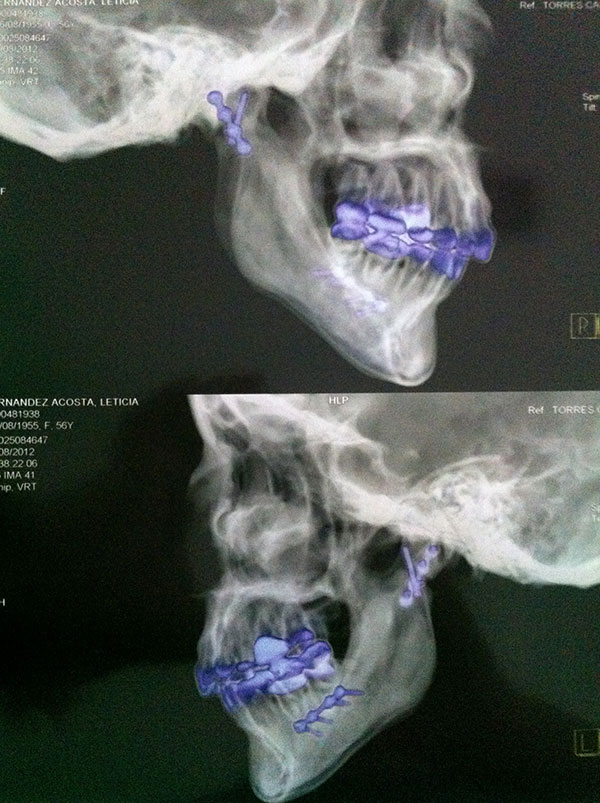 Reconstrucción Fractura mandibular Cirujano Maxilofacial CDMX