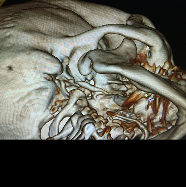 Reconstrucción Fractura mandibular Cirujano Maxilofacial CDMX