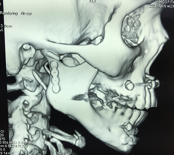 Reconstrucción Fractura mandibular Cirujano Maxilofacial CDMX