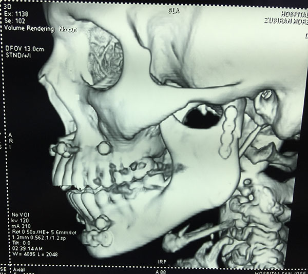Reconstrucción Fractura mandibular Cirujano Maxilofacial CDMX