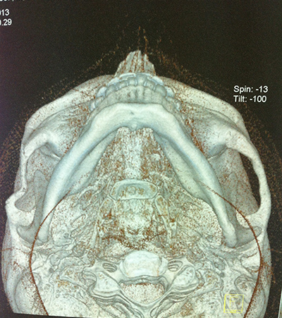 FRACTURA DE ARCO CIGOMÁTICO