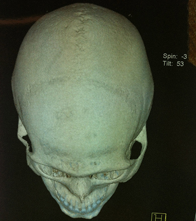 FRACTURA DE ARCO CIGOMÁTICO