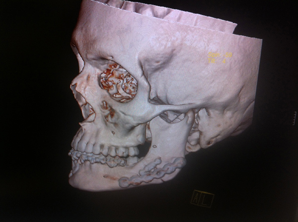 Reconstrucción Fractura mandibular Cirujano Maxilofacial CDMX