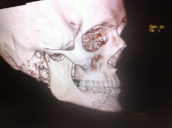 Reconstrucción Fractura mandibular Cirujano Maxilofacial CDMX