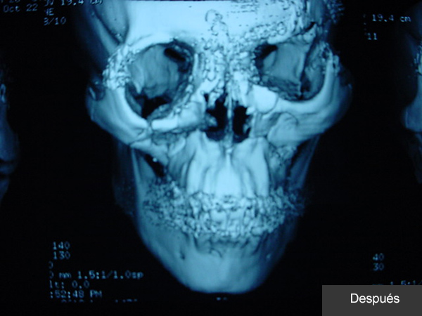 Reconstrucción Fractura mandibular Cirujano Maxilofacial CDMX