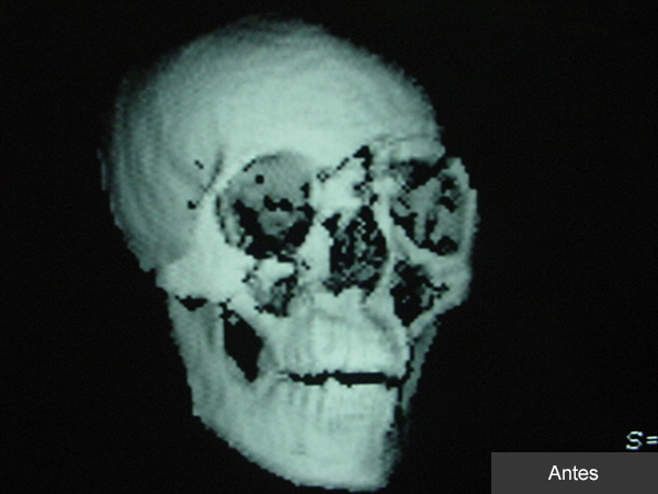 Reconstrucción Fractura LEFORT IV Cirujano Maxilofacial CDMX