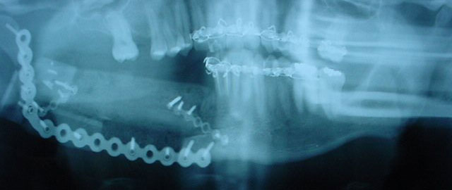Ameloblastoma