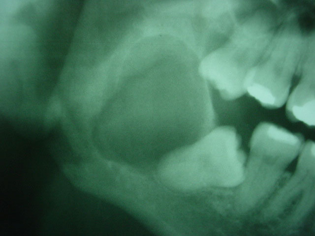 Ameloblastoma