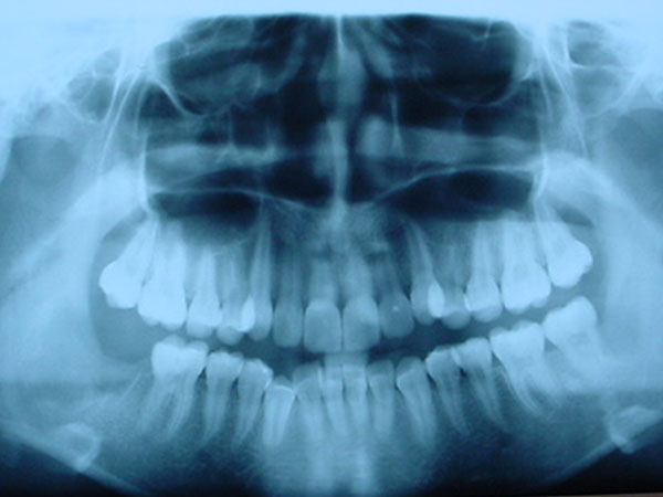 Fibromixoma asociado a un tercer molar