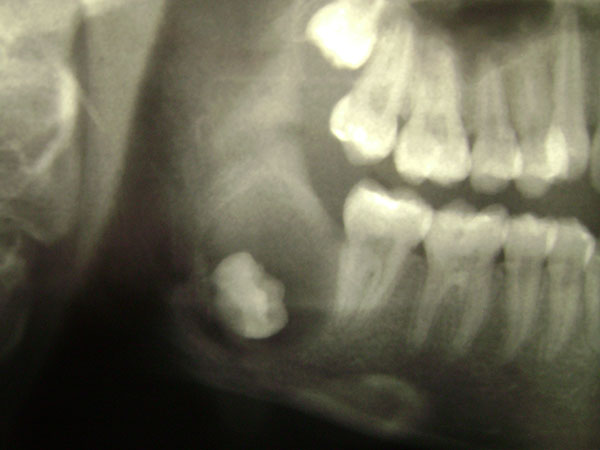 Fibromixoma asociado a un tercer molar