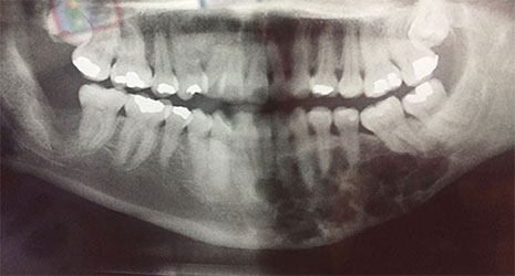 Mixoma odontogénico