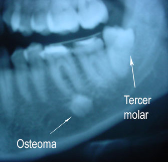 Osteoma: hiperdensidad ósea