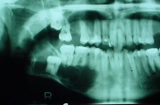 Queratoquiste asociado a tercer molar