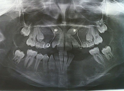 Seguimiento posterior