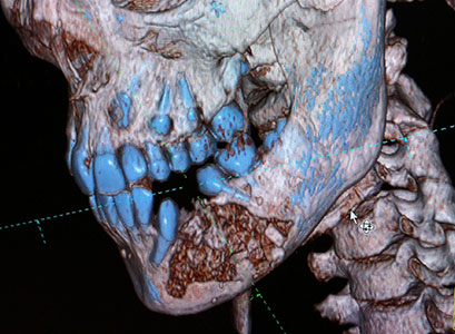 Seguimiento posterior