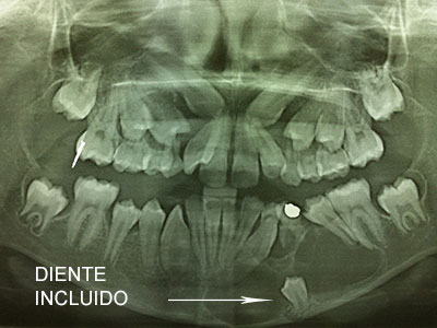 Queratoquiste por diente incluido