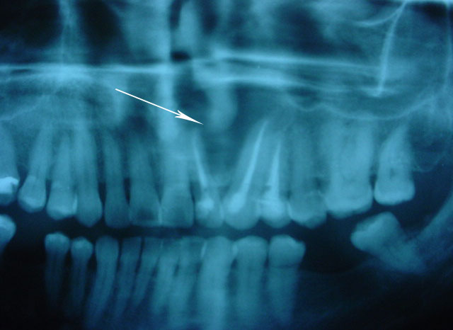 Quiste dentígero (post)