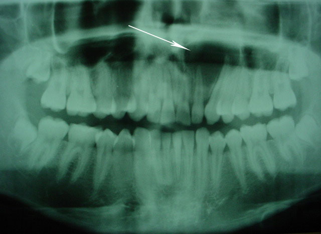 Quiste dentígero (pre)