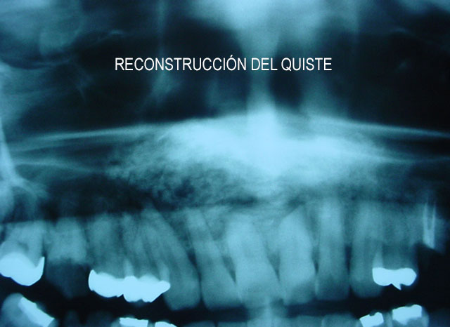 Reconstrucción de quiste periapical