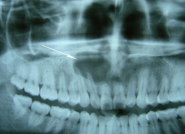 Quiste periapical