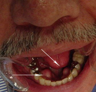 Torus mandibular