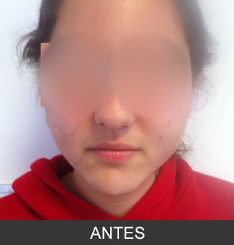 Bichectomía