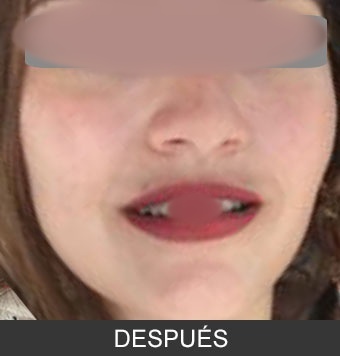 Bichectomía