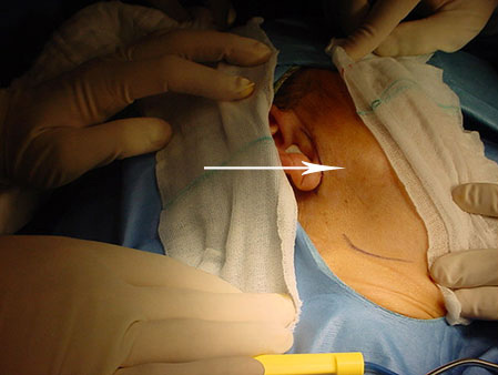 Parotid adenoma