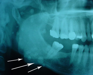 Stones in the parotid gland