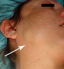 Stones in the parotid gland
