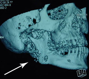 Stones in the parotid gland