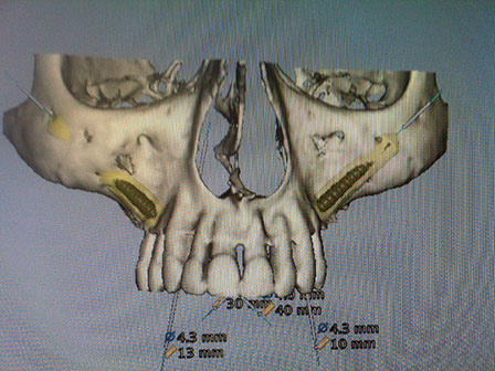 CAD CAM Cirujano Maxilofacial CDMX