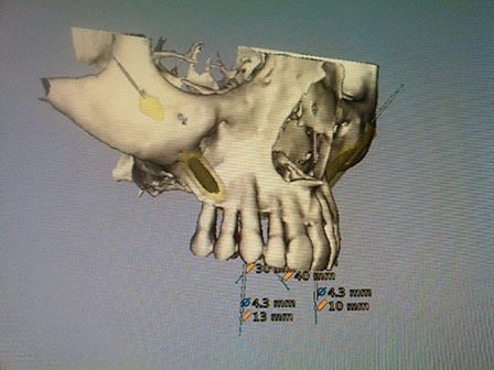 CAD CAM Cirujano Maxilofacial CDMX