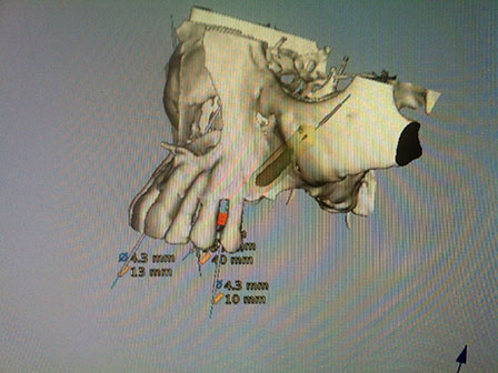 CAD CAM Cirujano Maxilofacial CDMX