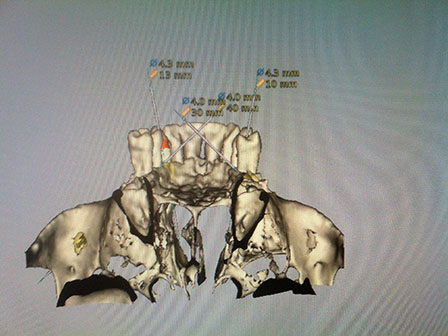 CAD CAM Cirujano Maxilofacial CDMX